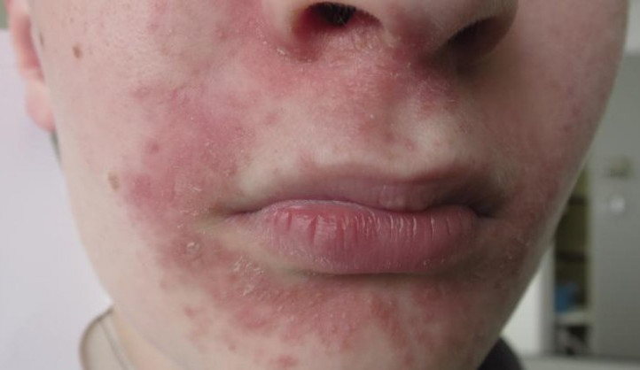 Letuščí nemocí trpí stále více žen a dětí. Způsobovat ji může třeba zubní pasta s fluorem