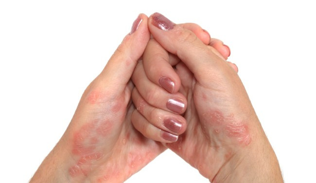 V Jihlavě proběhne seminář o lupénce. Lidé se na něm dozví, jak s kožní nemocí bojovat