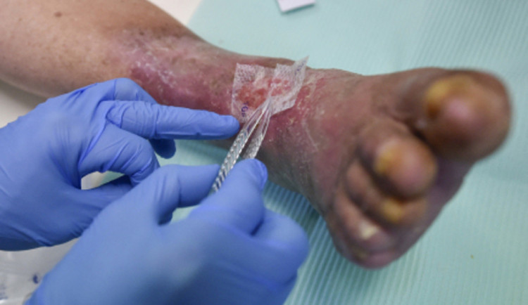 Jihlavská nemocnice nově léčí chronické rány membránou z placenty