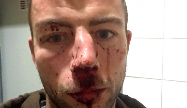 Jihlavský hokejista Michal Hlinka byl napaden. Skončil s otřesem mozku a zlomeným nosem v nemocnici