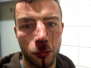 Jihlavský hokejista Michal Hlinka byl napaden. Skončil s otřesem mozku a zlomeným nosem v nemocnici