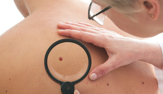 Den melanomu v Jihlavě: Zájemcům budou vyšetřena mateřská znaménka, je nutné se předem objednat