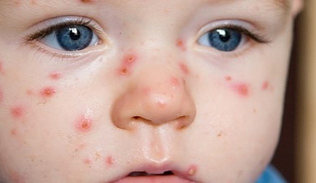 Plané neštovice se nevyhýbají ani jihlavským školkám. Nechat, či nenechat nakazit dítě?