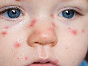 Plané neštovice se nevyhýbají ani jihlavským školkám. Nechat, či nenechat nakazit dítě?