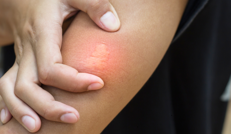 Co dělat při bodnutí vosou? Rady pro nealergiky i alergiky