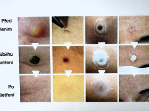 Pomoc za pár sekund. Pelhřimovská nemocnice nabízí ošetření speciálním perem