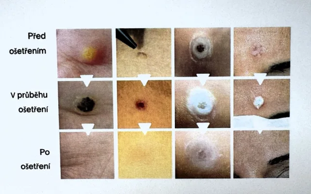 Pomoc za pár sekund. Pelhřimovská nemocnice nabízí ošetření speciálním perem